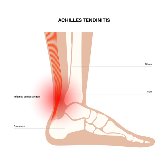 Achilles tendon injury