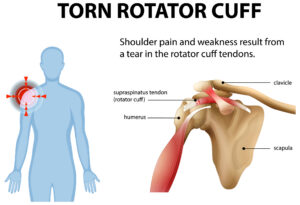 Illustration of shoulder anatomy and injury, rotator cuff injury, rotator cuff torn, therapy partners of north texas