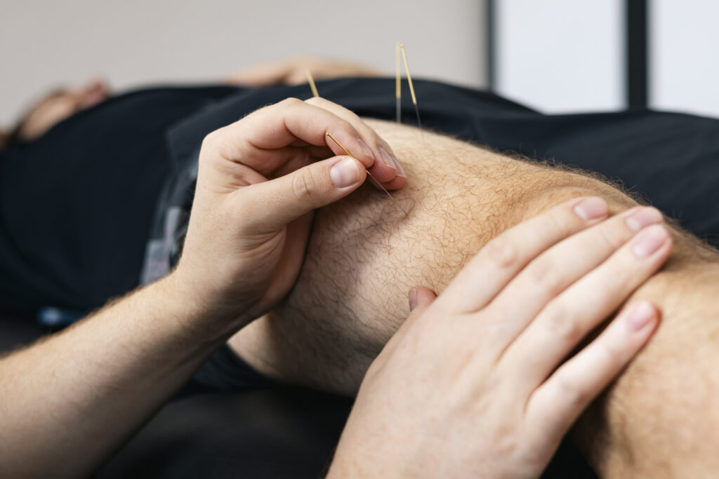 The Role of Physical Therapy in Dry Needling